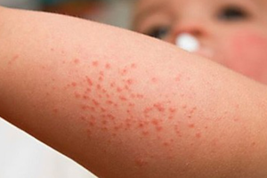 Số ca nhập viện vì sốt xuất huyết gia tăng, nhiều bệnh nhân bị sốc nặng
