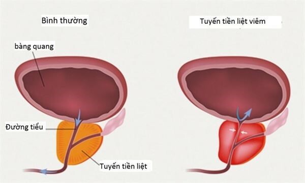 đau bụng dưới ở nam giới