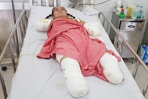 Dùng cây sắt hái xoài cho con, người phụ nữ bị điện giật mất cả tứ chi