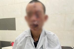 Nam thanh niên bị cháy sém toàn thân do dùng điện thoại đang sạc