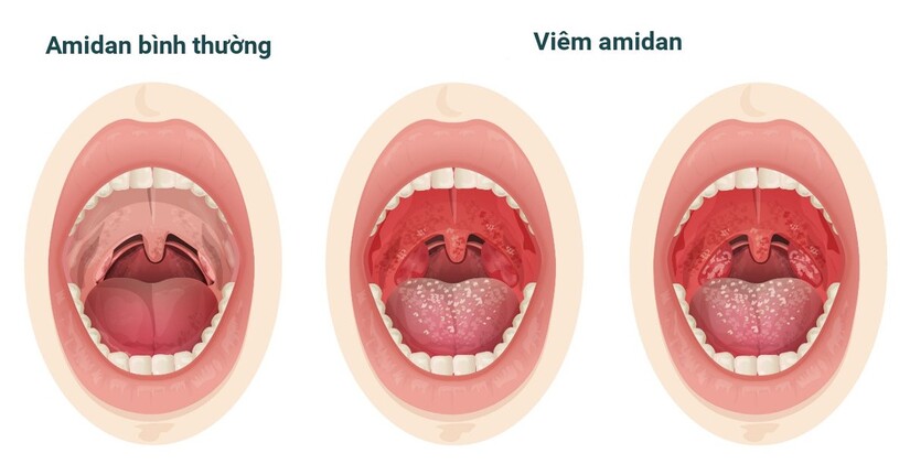 viêm loét miệng họng sốt cao