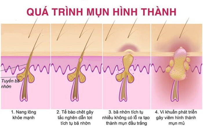 trị mụn hiệu quả tại nhà