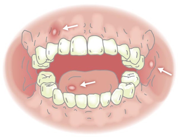 nhiệt lưỡi ở người lớn