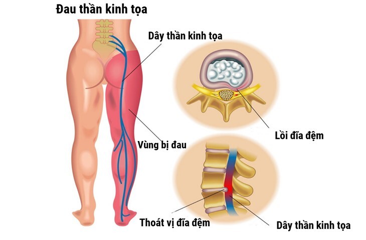 đau thần kinh tọa và cách điều trị