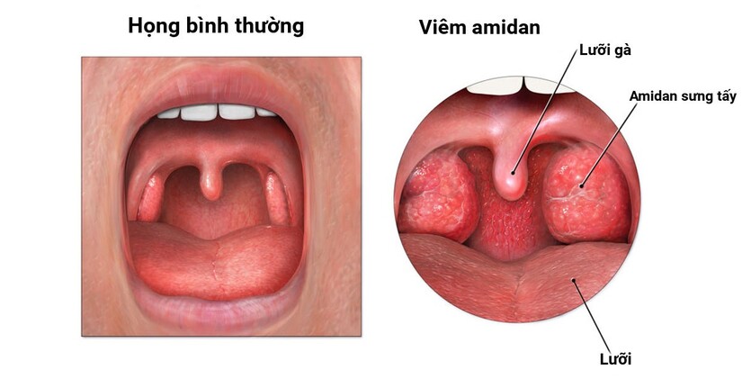 Viêm amidan uống thuốc gì