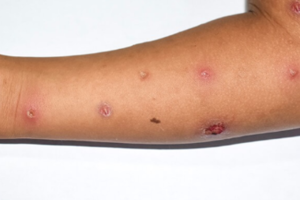 Bệnh đậu mùa khỉ diễn biến phức tạp, Bộ Y tế khuyến cáo 6 biện pháp phòng tránh