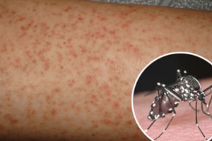 Cả nước ghi nhận 33.000 ca mắc sốt xuất huyết, dịch bệnh tăng nhanh tại phía Nam