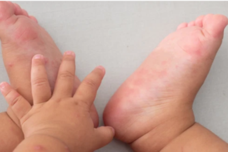 Hải Phòng: Số trẻ em nhập viện do mắc bệnh tay chân miệng tăng cao