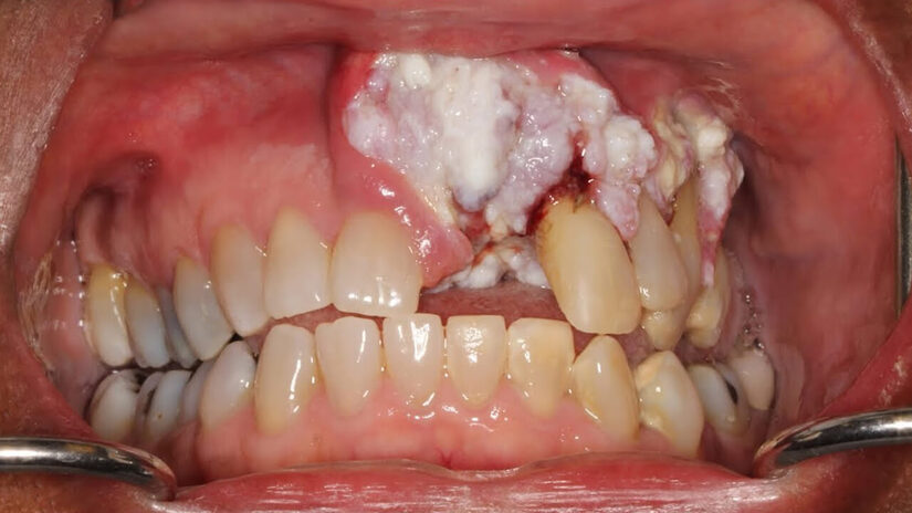 Ung thư nướu răng nguy hiểm thế nào? Biện pháp phòng tránh hiệu quả