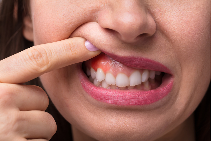 Ung thư nướu răng nguy hiểm thế nào? Biện pháp phòng tránh hiệu quả
