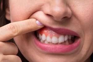 Ung thư nướu răng nguy hiểm thế nào? Biện pháp phòng tránh hiệu quả