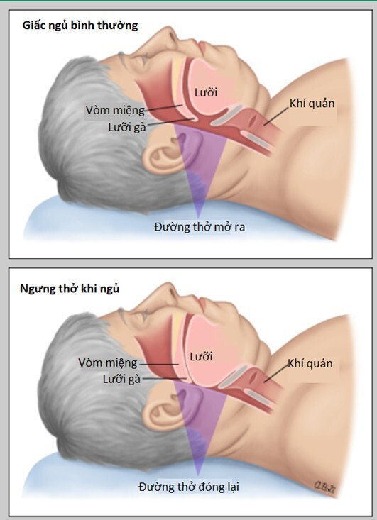 Ngủ chập chờn không sâu giấc