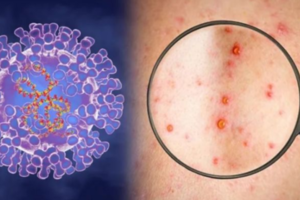 Ghi nhận 780 ca mắc bệnh đậu mùa khỉ tại 27 quốc gia chưa có dịch