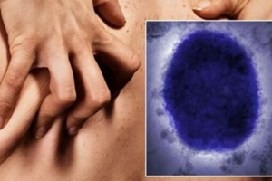 Cảnh báo những đường lây, biểu hiện ít ngờ của bệnh đậu mùa khỉ