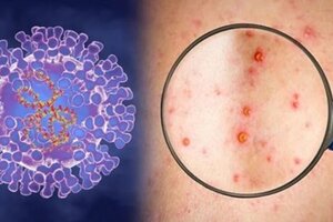 TP.HCM ứng phó thế nào khi có ca nghi mắc đậu mùa khỉ