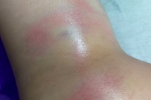 Xác minh vụ bé gái bị cô giáo đánh bầm tím cơ thể vì đi vệ sinh trong quần