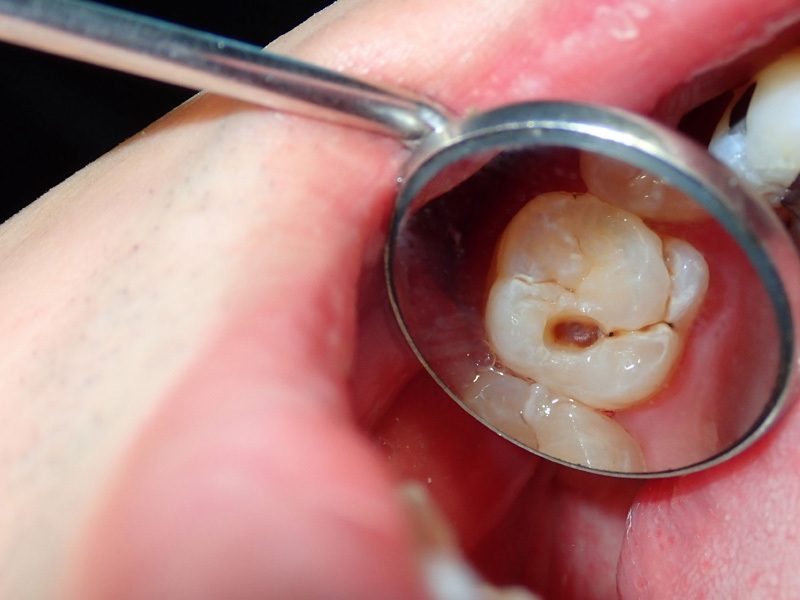 Đau răng sâu nên làm gì 