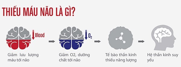 đau đầu vì thiếu máu lên não