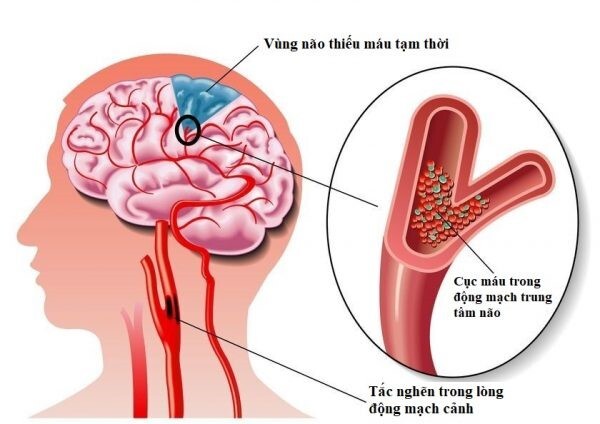 đau đầu vì thiếu máu lên não