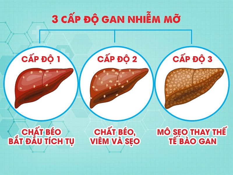 Gan nhiễm mỡ uống thuốc gì 