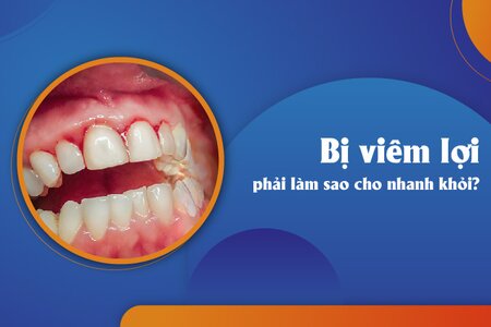 Giải đáp thắc mắc “Bị viêm lợi phải làm sao cho nhanh khỏi?”