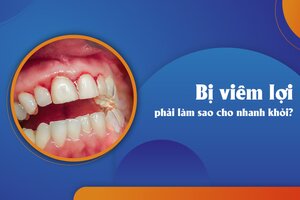 Giải đáp thắc mắc “Bị viêm lợi phải làm sao cho nhanh khỏi?”