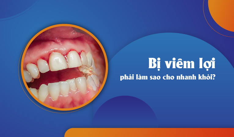 Bị viêm lợi phải làm sao