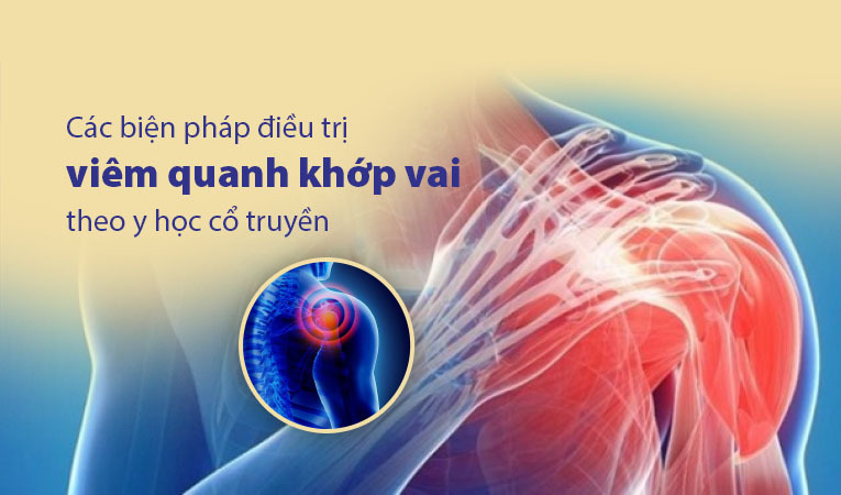 viêm quanh khớp vai