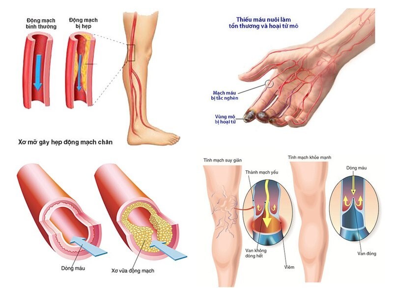 đau mỏi cổ vai gáy là bệnh gì