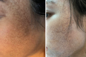 Mặt cô gái trẻ loang lổ vết trắng đen sau khi chi hàng chục triệu đồng làm đẹp ở spa