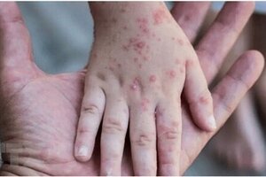 Bộ Y tế khuyến cáo 6 biện pháp phòng chống bệnh đậu mùa khỉ