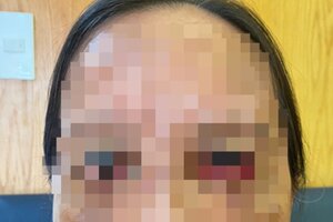 Cắt mí tại spa, lão bà ăn trái đắng