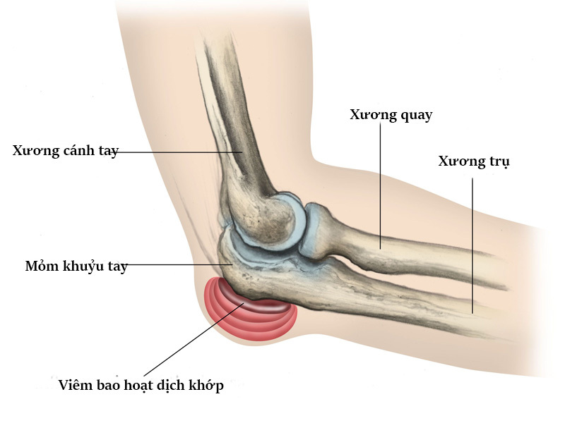 Đau nhức khớp khuỷu tay