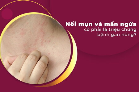 Nổi mụn và mẩn ngứa có phải là triệu chứng bệnh gan nóng?