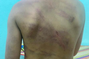 Chủ tịch tỉnh Bình Phước chỉ đạo khẩn sau vụ bé 7 tuổi bị cha dượng mẹ và mẹ ruột bạo hành