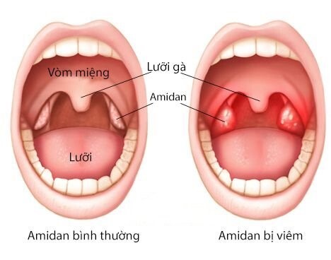 Đau họng lâu ngày