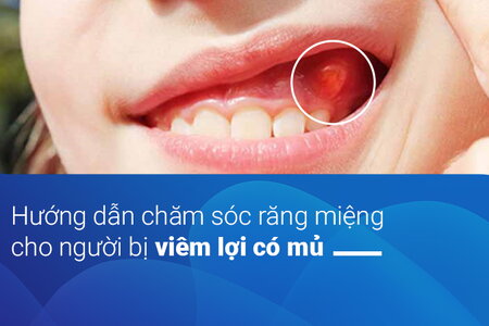 Hướng dẫn chăm sóc răng miệng cho người bị viêm lợi có mủ