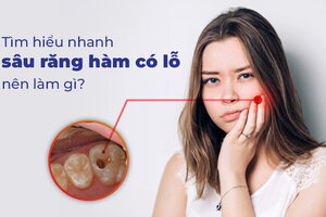 Tìm hiểu nhanh sâu răng hàm có lỗ nên làm gì?