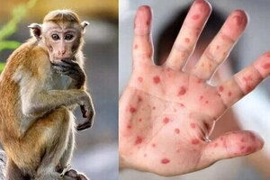 Hà Nội sẽ thiết lập đường dây nóng tiếp nhận thông tin về bệnh đậu mùa khỉ