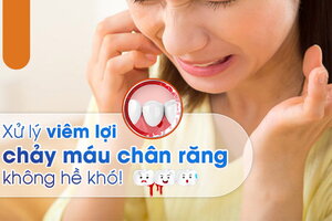 Xử lý viêm lợi chảy máu chân răng không hề khó!