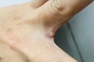 Zoom cận vết mụn nước ở người mắc đậu mùa khỉ đầu tiên của Việt Nam