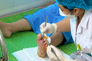 Người đàn ông phải tháo bỏ ngón chân do tự ý đắp thuốc lá chữa bệnh