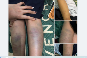 Xác minh vụ học sinh lớp 1 ở Đà Nẵng bầm tím khắp người sau khi đi học về