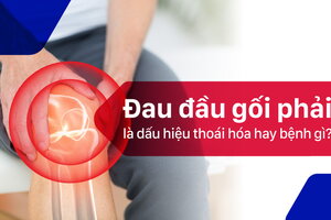 Đau đầu gối phải – là dấu hiệu thoái hóa hay bệnh gì?