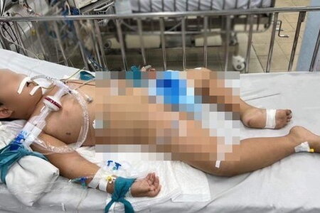 Bé trai 7 tuổi ở TP HCM bị viêm não hoại tử hiếm gặp