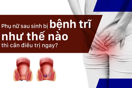 Phụ nữ sau sinh bị bệnh trĩ như thế nào thì cần điều trị ngay?