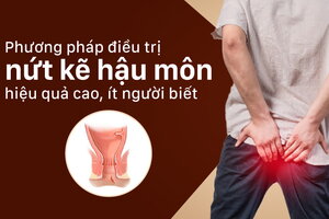 Phương pháp điều trị nứt kẽ hậu môn hiệu quả cao, ít người biết