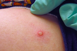 TP. HCM ghi nhận  ca bệnh đậu mùa khỉ thứ hai