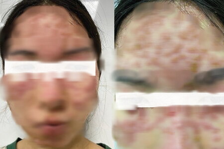 'Detox' da trị mụn tại spa, cô gái trẻ nhập viện với khuôn mặt biến dạng