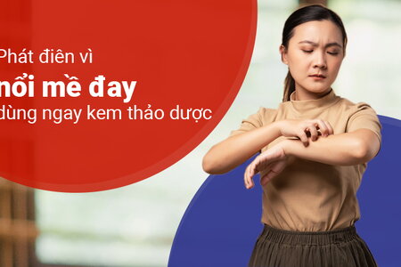 Phát điên vì nổi mề đay – dùng ngay kem thảo dược!